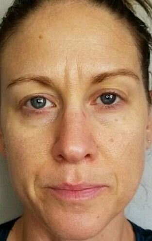 A la edad de 40 años, aparecen arrugas profundas y puntos de edad