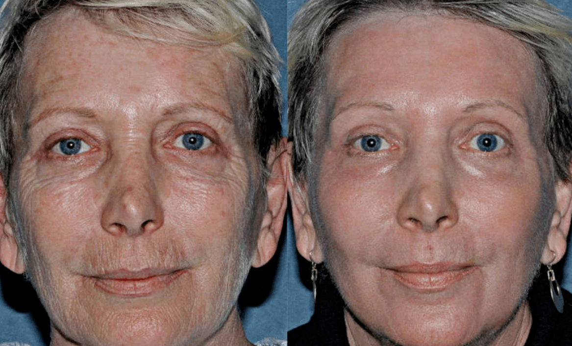 antes y después